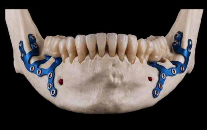 Exo Implante Estrutura total inferior - Estabilidade mandibular