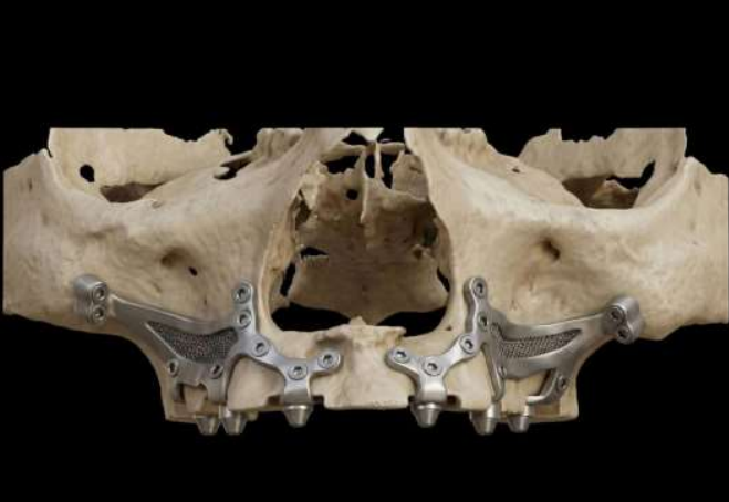 Exo Implante Prótese Híbrida Bimaxilar Total com Zigomática