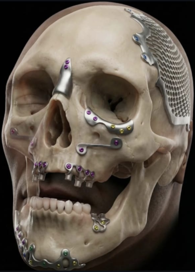 Exo Implante Skull Visual